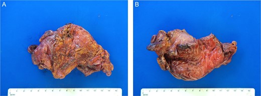 Gross pathology photos of surgical specimen. (A) External surface of the resected bowel. (B) Internal surface of the resected bowel.