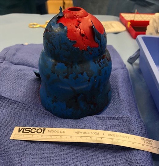 Intraoperative photo of the rectal foreign object.