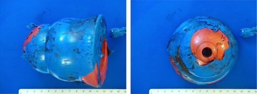 Postoperative photos of the rectal foreign object.