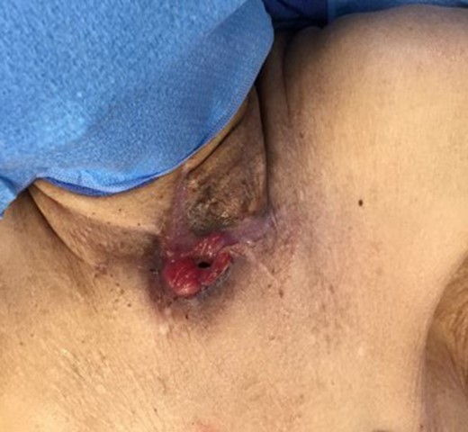 Cutaneous fistula.