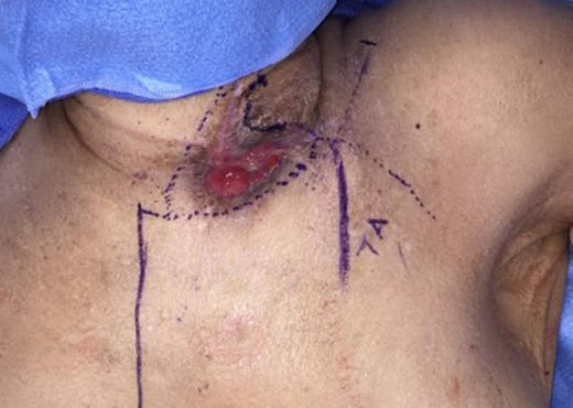 Preoperative markings.