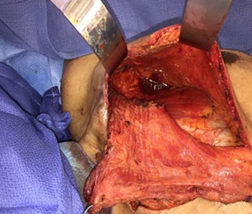 Released humeral attachment.