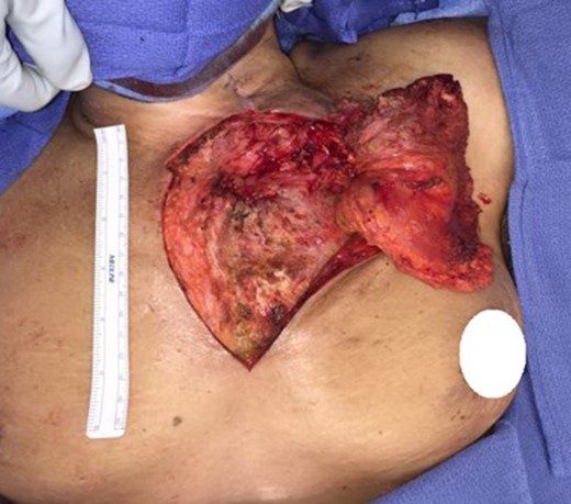 Completely detached flap.