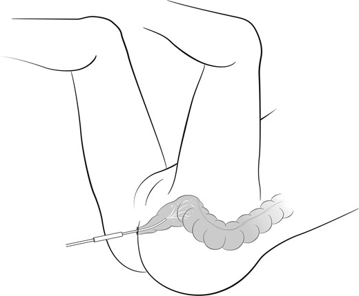 Rectal lavage to wash out the rectum and prevent fecal contamination of the pelvic anastomosis.
