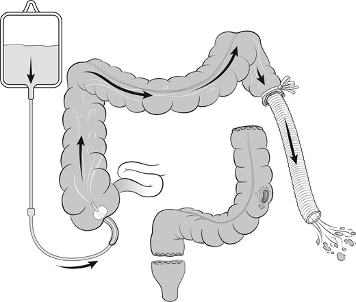 Colonic lavage cleansing the colon and extent of resection shown prior to anastomosis.