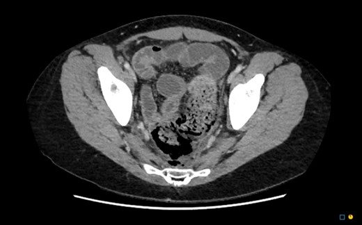 CT axial. Free gas within the pelvis around the rectum as well as pneumointestinalis of the rectum suggestive of ischaemia and perforation.