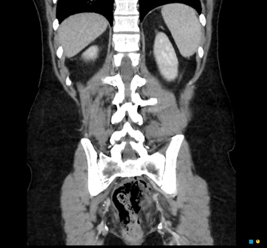 CT coronal. Pneumointestinalis of the rectum suggestive of perforation.