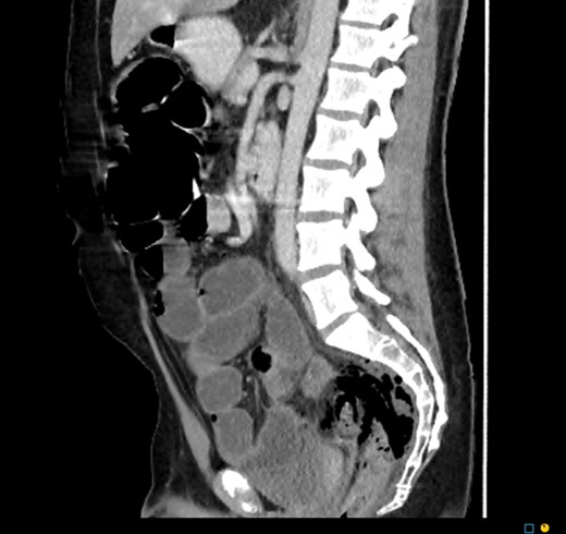 CT sagittal. Large amount of perirectal free gas consistent with rectal perforation. The rectum is thick-walled and oedematous suggestive of ischaemia.
