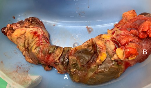 (A) Rectal gangrene with multiple sites of perforation. (B) Healthy rectosigmoid at proximal resection margin.