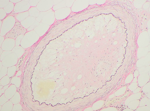 Elastin highlighting the internal elastic lamina (IEL). Elastin confirms luminal narrowing secondary to intimal thickening.