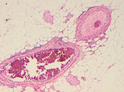 Marked arterial luminal stenosis and marked thickening of intima. The adjacvent small vein also demonstrates transmural phlebitis and slight thickening of its intima.