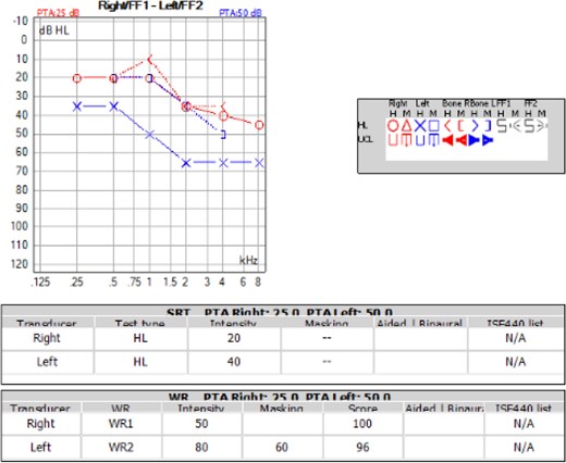 Audiogram of the patient showed left sided mixed hearing loss and right sided sensorineural hearing loss. Word recognition was normal bilaterally.
