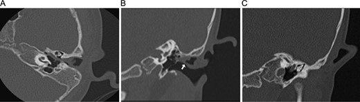 CT of the temporal bones without contrast, with bone windowing. (A) Axial scan showing the mass extending into the middle ear, past the ossicles and toward the eustachian tube. (B) Coronal scan revealing the fistula of the external auditory canal (arrow), with the mass extending from that area into the middle ear. (C) Coronal scan with small epitympanum and ossicular view.
