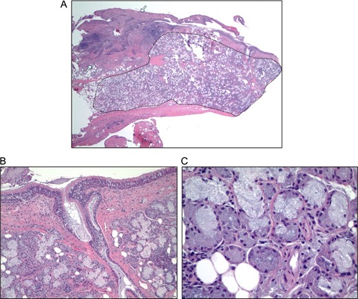 Hematoxylin and eosin (H&E) stained micrographs of the specimen. (A) Low power H&E of the specimen, showing areas of fibrosis (between arrows) and glandular tissue composed of serous and mucinous cells typical of submandibular salivary gland (surrounded by dotted line). (B) Higher power H&E shows the salivary glandular tissue with connection to the surface (bottom portion of image) and overlying ciliated columnar epithelium (at top of image). (C) High power H&E shows the admixture of cell types with the darker granular serous cells and the pale blue mucinous cells.