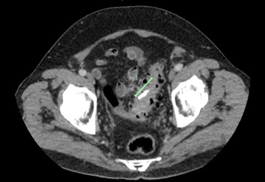 CT demonstrating a radio-opaque foreign body (marked) in segment of sigmoid diverticulosis, with stranding extending to adjacent loop of small bowel.