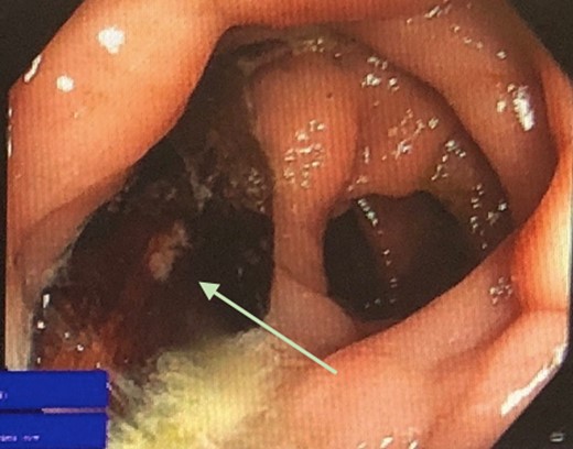 Colonoscopic view of foreign object within segment of sigmoid diverticulosis.