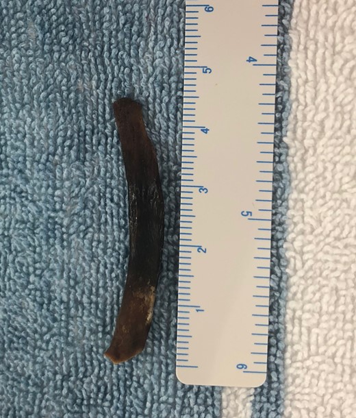 Foreign object, post-colonoscopic extraction.