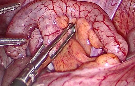 Laparoscopic view of the bifid appendix.