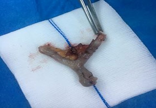 Gross view of the bifid appendix.