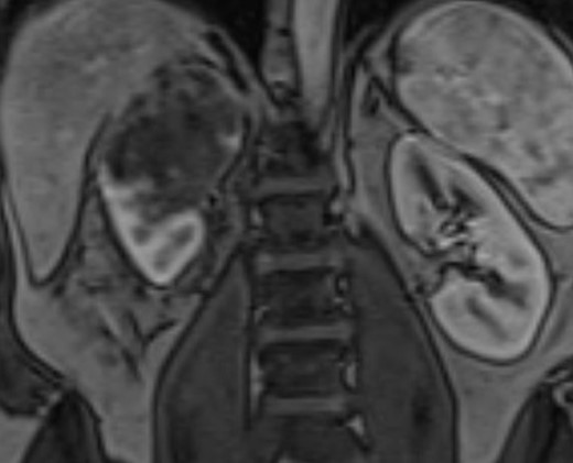 Coronal MRI of the abdomen/pelvis demonstrating the 8 cm right upper pole renal mass.