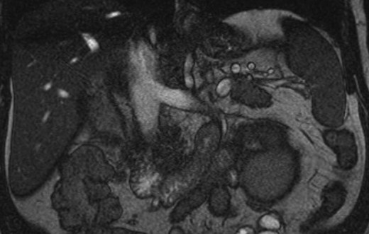 Coronal MRI of the abdomen/pelvis demonstrating no evidence of caval thrombus. The right renal vein was not visible on MRI.