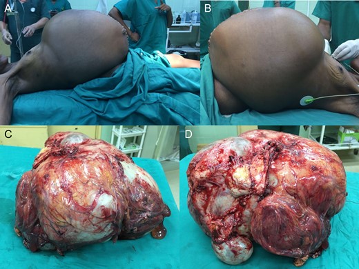 Giant incomplete Meigs’ syndrome at presentation (A and B) and the excised mass (C and D).