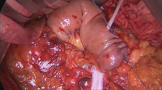 AM displacement begins from posterior face of pancreo-jejunal anastomosis.