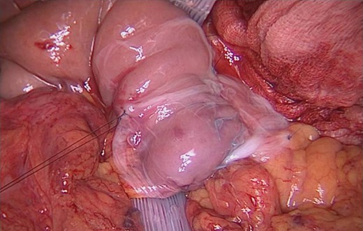 AM surrounds the entire PJ anastomosis and it is fixed to surrounding tissue by single stiches.