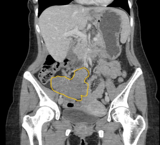 CT imaging demonstrating a 9 cm lesion in the right iliac fossa, displacing adjacent small bowel.
