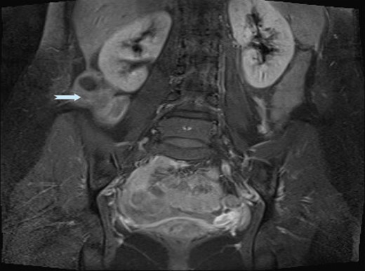 MRI images demonstrating ALL with vascular pedicle attached to liver.