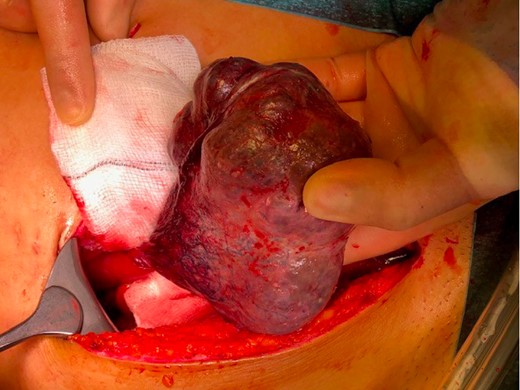 ALL with torted vascular pedicle causing ischaemia of the lobe.