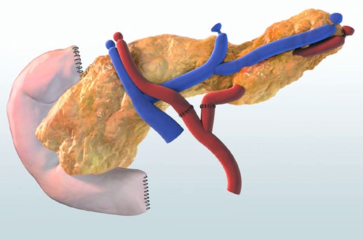 Graphic representation of a pancreas prepared for transplantation. A Y-shaped piece of iliac donor artery is used to facilitate arterial vascular anastomosis (picture courtesy of Leiden University Medical Center).