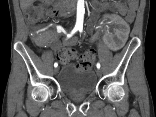 Elective CT scan showing pseudoaneurysm of the vascular reconstruction, most likely at the site of the anastomosis between Y graft and splenic artery.