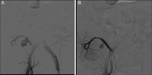 (A) Emergency angiography showing increased Y graft aneurysm. The splenic artery is not perfused. (B) Stent placed through the Y graft and SMA, covering the aneurysm and origin of the splenic artery.