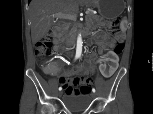 Follow-up CT scan showing a patent SMA tract with stent in position and no signs of endoleak.