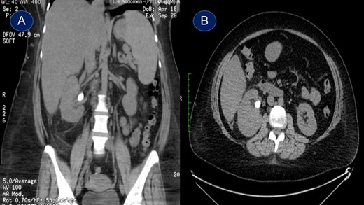 Plain abdominopelvic CT scan, coronal view (A) and axial view (B) showing right renal pelvic stone measuring 20 mm.