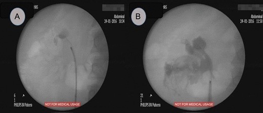 Fluoroscopic study, (A) showed a radiopaque shadow at level of L2, (B) showed extravasation of contrast at the end of surgery.