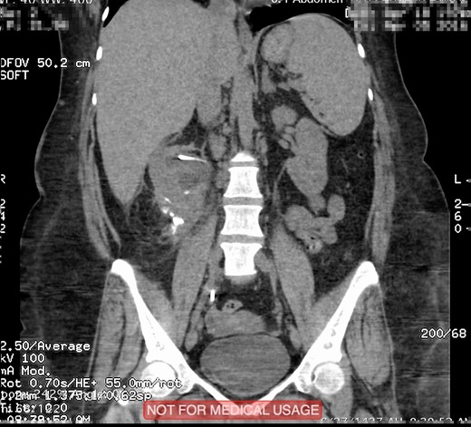 Plain abdominopelvic CT, coronal view showed migrated stone fragments into the regressed right subcapsular renal hematoma.