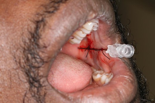 Picture showing two sutures are placed to secure the catheter intra orally. The cannula is reviewed to ensure is doesn’t come into contact with the dentition.