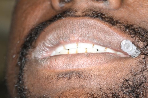 Picture showing the catheter portal accessibility for regular delivery of plain bupivacaine.