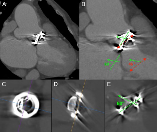 (A) Cardiac computed tomography (CT) angiography revealed a saccular ascending aortic aneurysm (maximum transaortic diameter: 51 mm) arising from the posterior ascending aortic wall just above the sino-tubular junction. (B) Cardiac CT angiography (systolic images) confirmed that the Björk-Shiley valve was tilted by the elevation of the prosthesis in the right-coronary sinus. Red dashed line: Aortic annulus (Basal ring), Green solid line: Prosthetic valve ring, Green solid arrow: Prosthetic valve leaflet. Physiologic opening angle calculated between the leaflet of the prosthetic aortic valve and the aortic annular plane was 45 degrees. (C, D, and E) Prosthetic heart valve assessment with cardiac CT (systolic images). Short axis view (C), frontal view (D), and lateral view (E) of the Björk-Shiley spherical-disc valve in the aortic position. Multiplanar reconstruction (MPR) image analysis revealed a normal leaflet opening angle of 60 degrees.