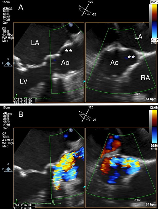(A) Transesophageal echocardiography (TEE) revealed a saccular ascending aortic aneurysm arising from the posterior ascending aortic wall just above the sino-tubular junction. (B) TEE with color Doppler revealed eccentric systolic flow jets through the tilting disc valve prosthesis directly impinging on the saccular aneurysm. Ao: aorta; LA: left atrium; LV: left ventricle, RA: right atrium; Double asterisk: saccular aneurysm.