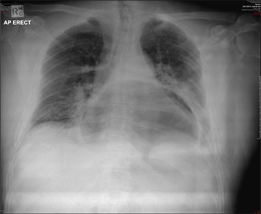 Chest X-ray revealing a large intra-thoracic gas bubble.