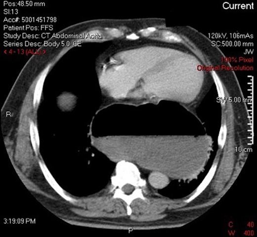 CT demonstrating obstructed intra-thoracic stomach in mesenteroaxial alignment.