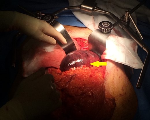 Intraoperative photograph identifying infarction of the greater curvature of the stomach.