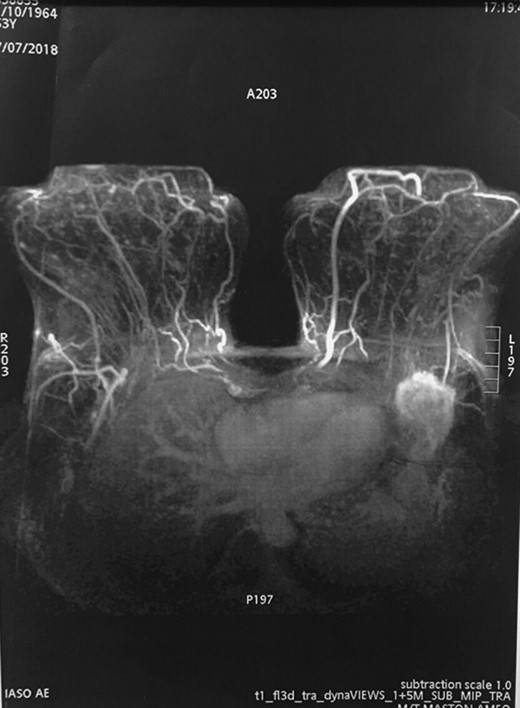 MRI detected the tumor in the left axilla. However, it cannot clarify whether the tumor is part of the tail of Spence or metastasis of the axillary lymph nodes.