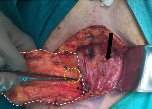 Meticulous exposure of the operating field. Yellow circle: the malignant tumor, white outline: upper external quadrant of the left breast and the left tail of Spence, thin arrow: clavipectoral fascia, thick arrow: pectoralis major.