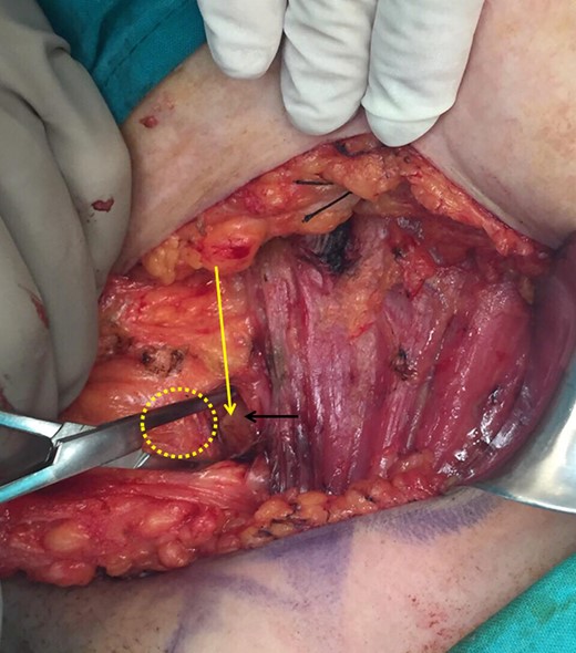 Yellow circle: the malignant tumor, black arrow: clavipectoral fascia, yellow arrow: incision of the clavipectoral fascia reveals if the mass is lymphatic or part of the axillary tail of Spence.