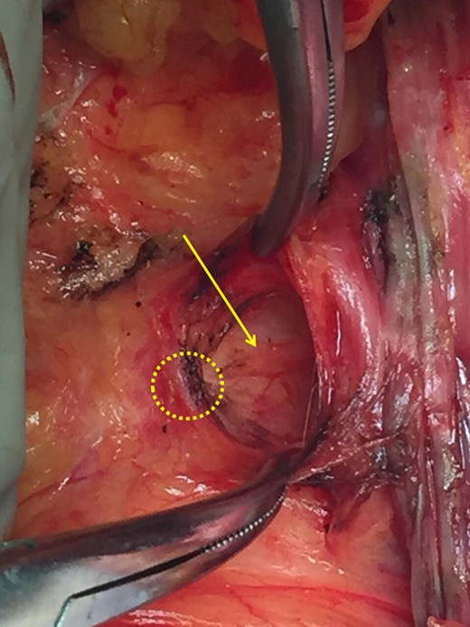 Yellow circle: the malignant tumor, black arrow: clavipectoral fascia, yellow arrow: incision of the clavipectoral fascia reveals if the mass is lymphatic or part of the axillary tail of Spence.