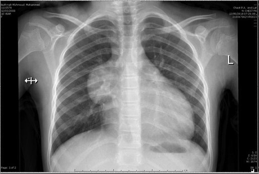 Pre-operative chest X-ray.